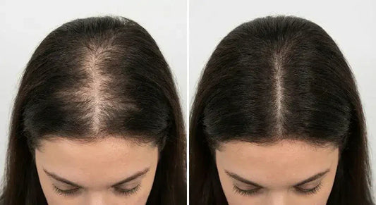 PCOS Hair Loss